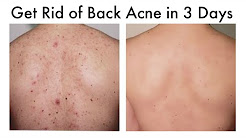 How to Get Rid of Back Acne At Home in 3 Days