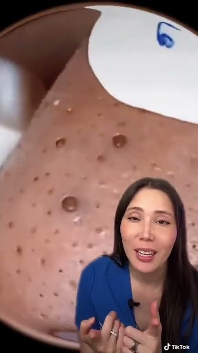 Blackhead removal