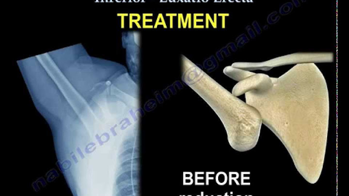 Anterior inferior dislocation of the humeral head là gì năm 2024