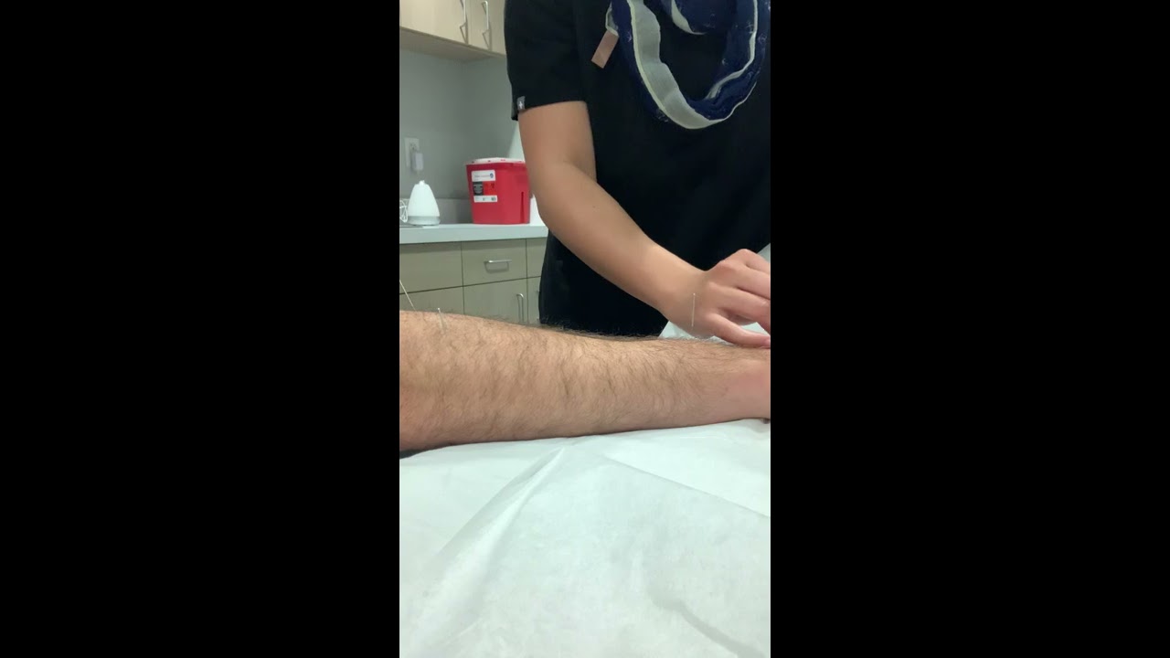 How to Treat Carpal Tunnel with Acupuncture