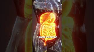 PÓLIPO INTESTINAL É UM PERIGO!!