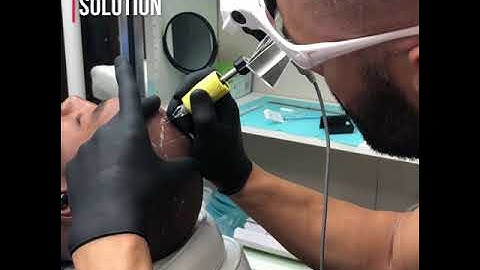 Scalp Micropigmentation by Antonio Baroque (demonstration )