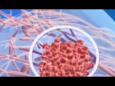 কি কারণে মেয়েদের স্তন ক্যান্সারের হয় দেখে নিন | bangla Women health tips