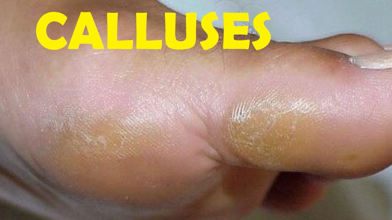 how to get rid of calluses on big toe YouTube