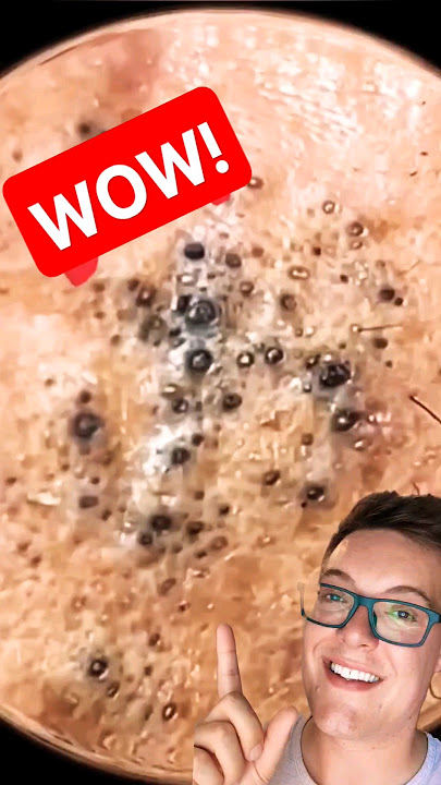 Ultimate BLACKHEAD REMOVAL 2024 - Speechless #shorts