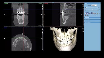 Romexis: Aligning Scan on Specific Tooth