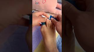 treatment line of bunion 🙏