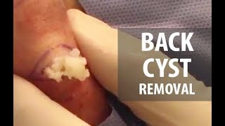 Back Cyst Removal | Dr. Derm