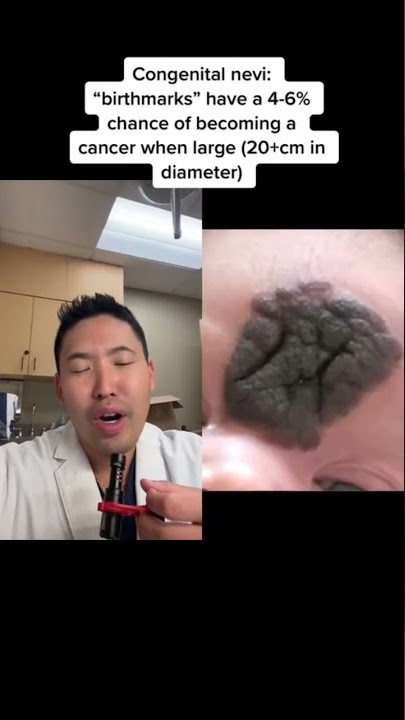 #shorts Congenital Nevus removed from the face