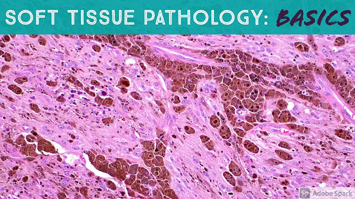 Basic Soft Tissue Pathology & Bone Tumor Cases: Explained by a Sarcoma Pathologist