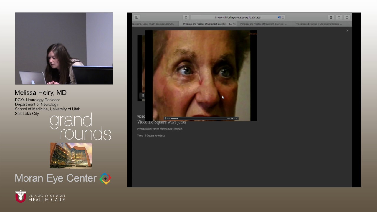 http://clinicaltrials.gov GR 02 08 17 Heiry Neuro Ophthalmologic findings in Progressive Supranuclear Palsy