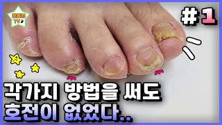 eng[1]직접 발톱을 갈고 뽑아 봤지만 아무런 효과가 없었어요｜레푸스 서면점/사상점/남포점｜문제성발톱｜ingrown toenail｜Athlete&#39;s foot-Fresh Foot