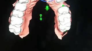 Digital Othodontics - Clear Aligners invisalign made with CEREC® and 3D Printer