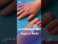 تورم اليدين والقدمين علامة تحذيرية mp3