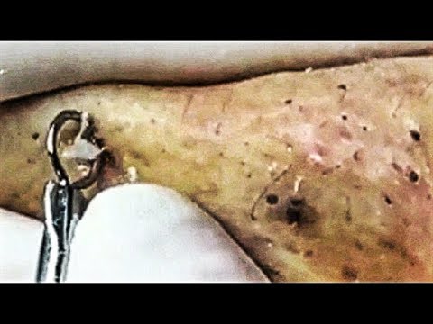 Satisfying Video Acne, Blackheads Removal with Relaxing Music Sleep (Part )