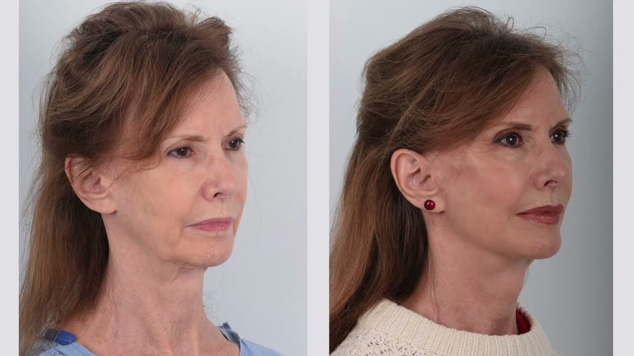 Awake Bloodless Facelift Surgery NO General Anesthesia Deep Plane