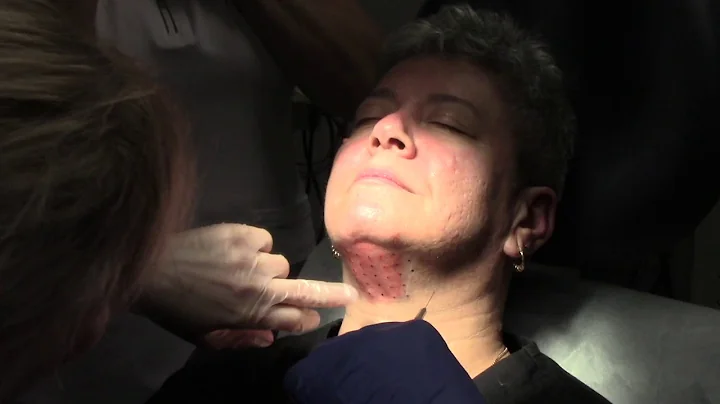 Kybella Treatment Destroys Double Chin with Dr.Jen...