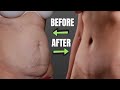 How To Fix Loose Skin | Dr. Jason Martin