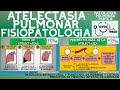 ATELECTASIA PULMONAR FISIOPATOLOGÍA | GuiaMed