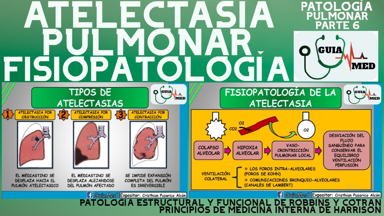 ATELECTASIA PULMONAR FISIOPATOLOGÍA | GuiaMed