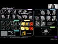 Rapid, high fidelity cardiac MR in adult and pediatric patients powered by Sonic DL