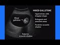 Types of Gallstones | Ultrasound Diagnosis and Features Explained