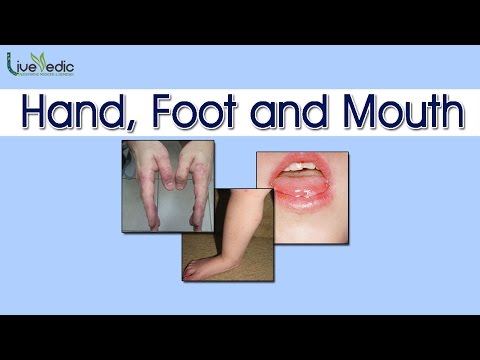 diy:-best-cure-for-kids-hand,-foot-&-mouth-disease-with-natural-home-remedies-|-live-vedic