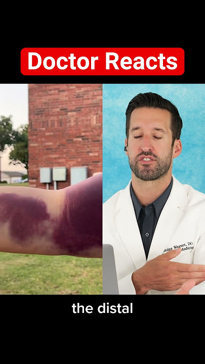 ER Doctor REACTS to World's Largest Bruise