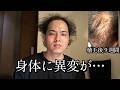 34歳ハゲ、植毛から９週間。突然眠れなくなりました…