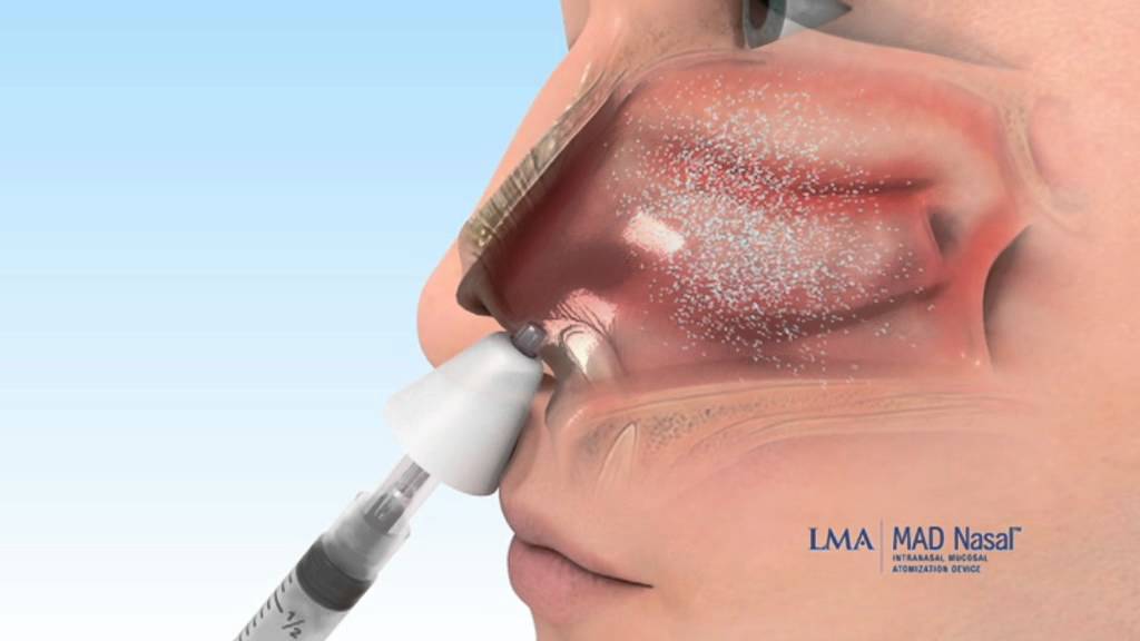 SEARCH AND BUY THIS PRODUCT MAD Nasal™ - Français - YouTube