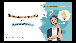 2- Pseudolymphoma Vs. Classic Mycosis Fungoides