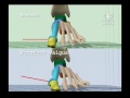 Comparison of Normal Gait to Forefoot Valgus Gait