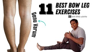 How to Correct Bow Legs with Exercises? Genu Varum Correction Exercise