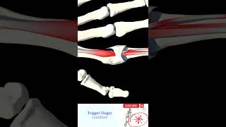 Trigger Finger causes and treatment #shorts