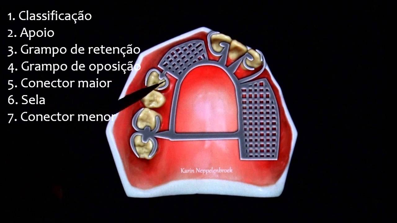 Planejamento - Classe II de Kennedy com modificações