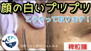 目の周りの白いプツプツ 稗粒腫のお話