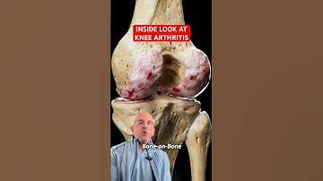 What Knee Arthritis REALLY Looks Like 👀 #shorts