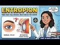 Entropion Causes, Types & Treatment | Ophthal Made Easy 🔥