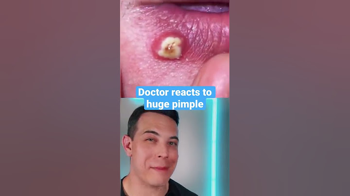 HUGE Painful Pimple on the￼ lip! | 208SkinDoc