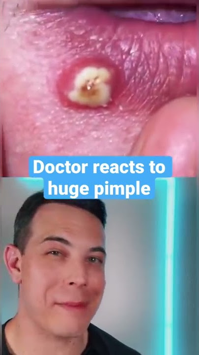 HUGE Painful Pimple on the￼ lip! | 208SkinDoc