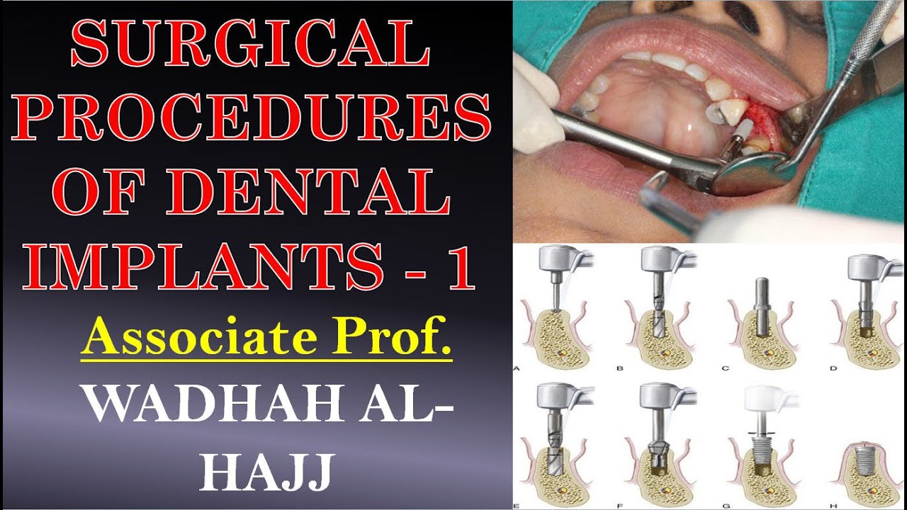 12 Surgical procedure of dental implants 1 Dr Wadhah implantology lectures. د/ وضاح الحاج
