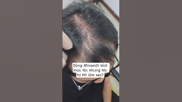 Dùng Minoxidil kích mọc tóc chỉ lên tóc tơ thì phải làm sao?