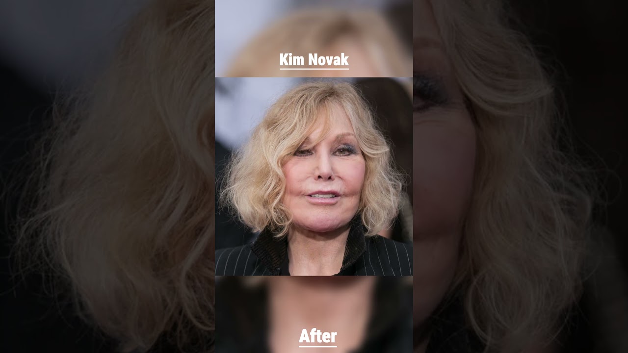 Biggest Plastic Surgery Fails 