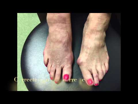 Lapidus Bunion Correction