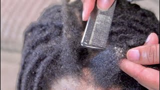 Treating Locs with Love | Flakes &amp; Build-Up Removal | ASMR