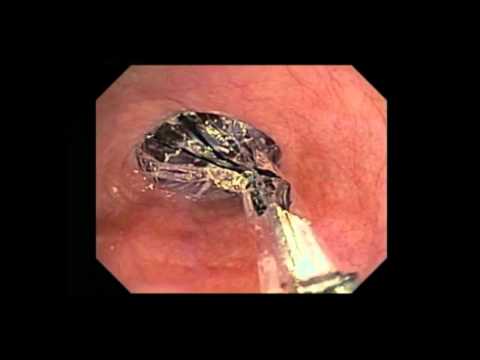 What to Expect from Your Nasal Endoscopy at Children's Hospital Colorado. What to Expect from Your Nasal Endoscopy at Children's Hospital Colorado.