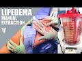 Live from behind the scenes in the or  total lipedema care