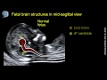 Open spina bifida at 11-13 weeks' gestation: brainstem