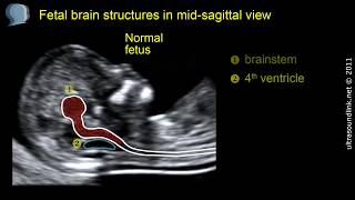 Exclusive Open spina bifida at 11-13 weeks' gestation: brainstem Information