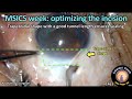 Cataractcoach 1463 msics optimizing the incision